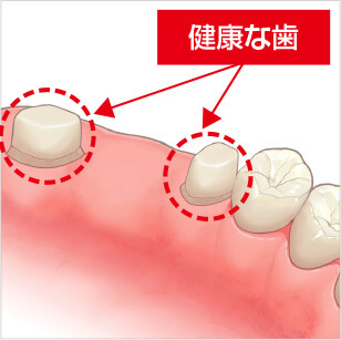 ブリッジによる治療の場合失った歯の両隣の歯を削る